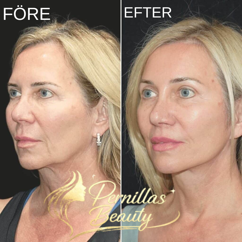 Dermalift-Uppstramande Ansiktslyft